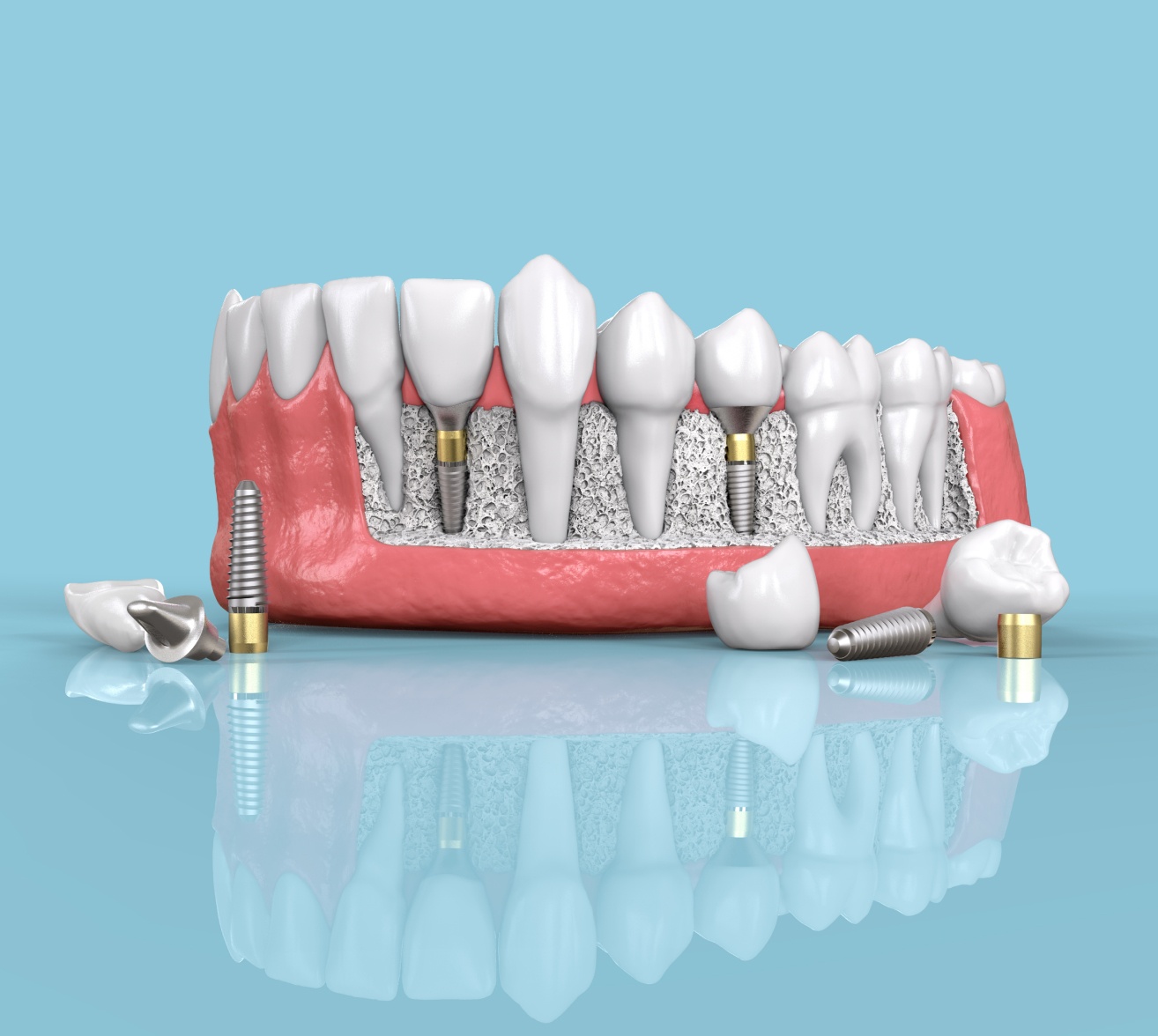 Implant dentaire | implant dentaire pas cher | Institut de chirurgie du visage | Bordeaux
