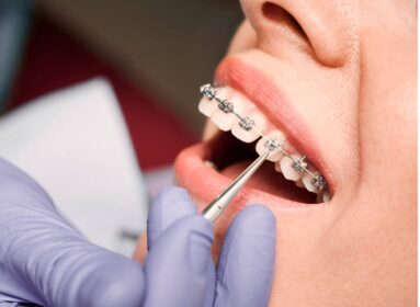 Pourquoi réaliser un traitement orthodontique avant une chirurgie orthognathique ? | Institut Chirurgie du visage | Bordeaux